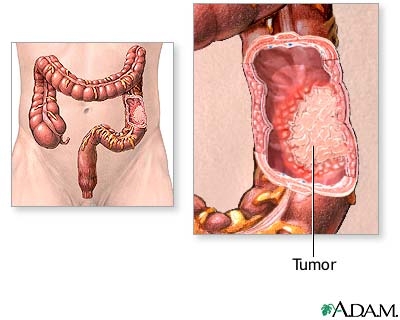 imagine cu cancerul intestinal